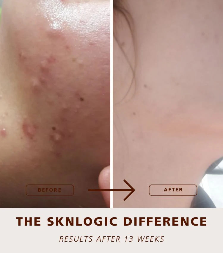 SknLogic Clarify 75ml