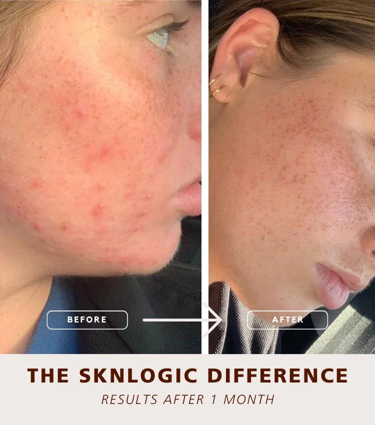 SknLogic Clarify 75ml